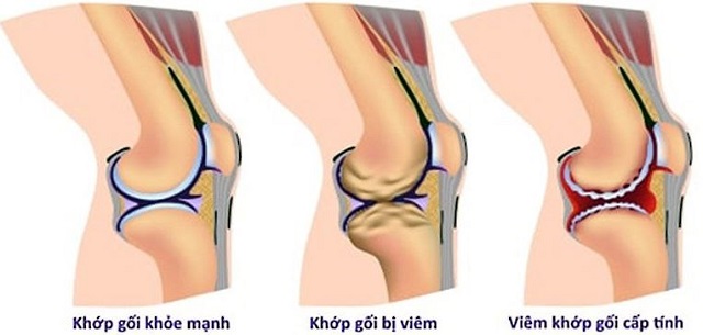 Ngủ Dậy Bị Đau Đầu Gối 2