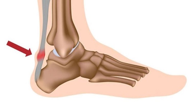 ngủ dậy đi bị đau gót chân